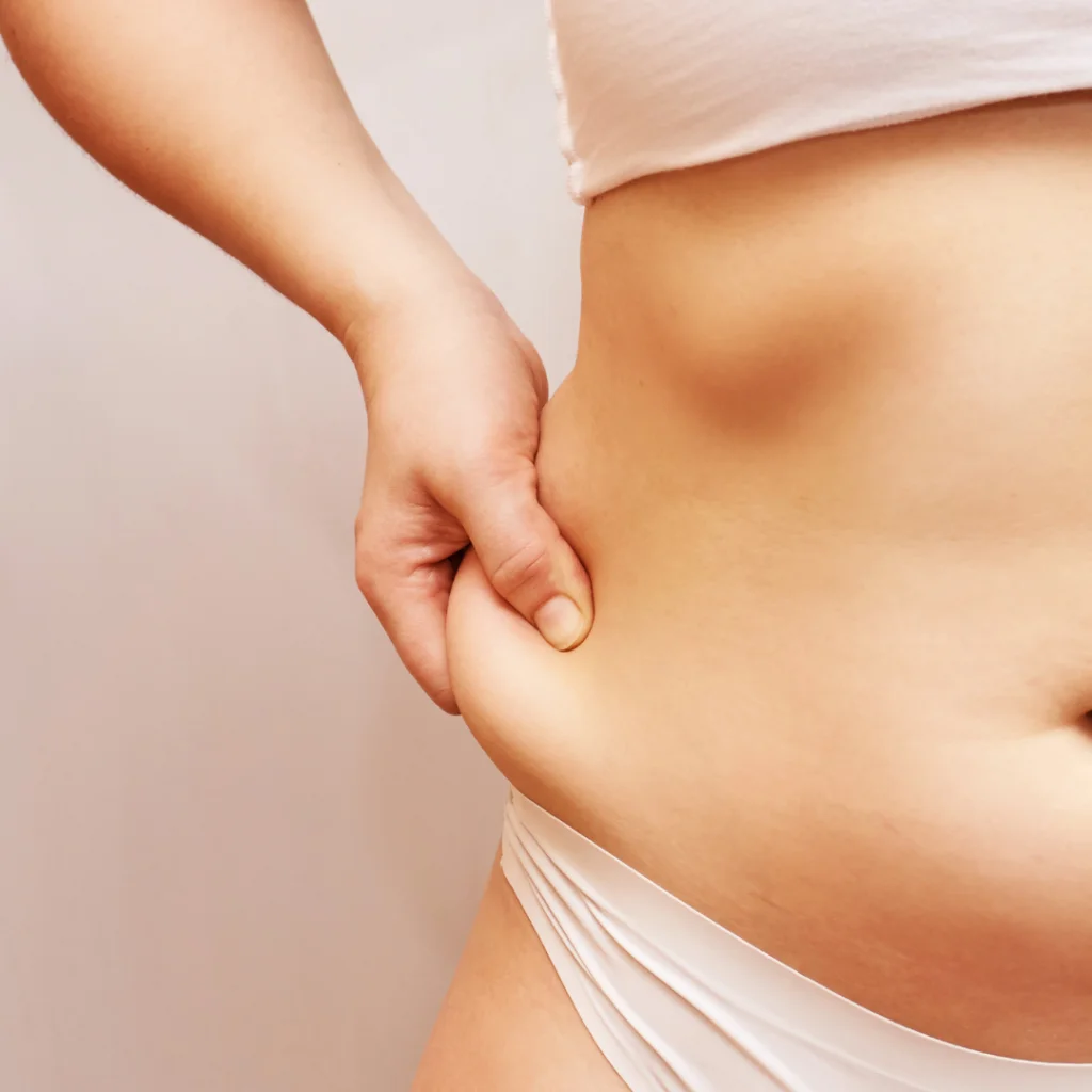 Abdominoplastia pelo Convenio do Plano de Saúde